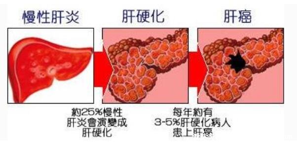 7大肝硬化早期症状，警惕蜘蛛痣和肝掌的出现