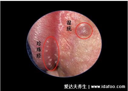 假疣和真疣的区别图，不要把这两个认错了