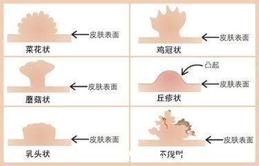 假疣和真疣的区别图，不要把这两个认错了