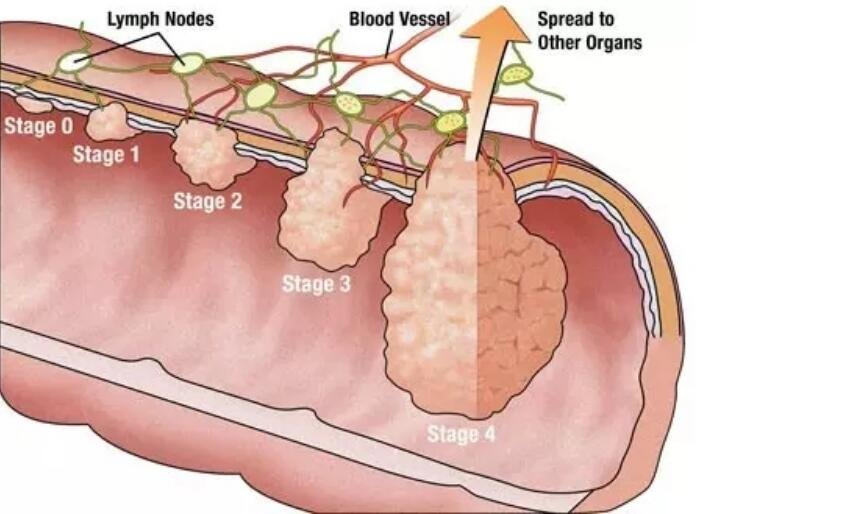 结肠癌的早中晚期的症状和表现，有这些症状的人可千万要注意了