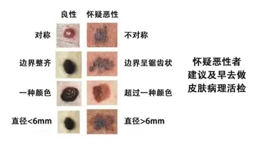 良性黑色素痣图片，长在表皮的交界痣很危险（容易恶化）