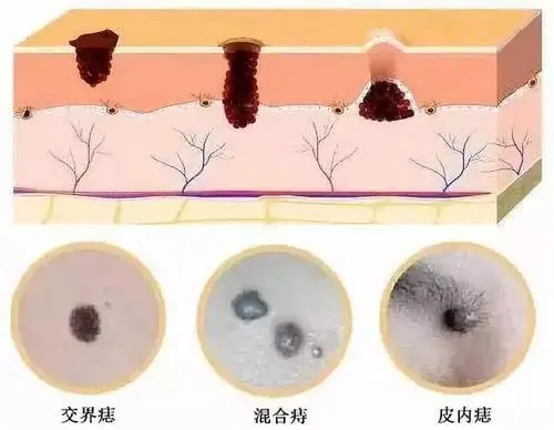 良性黑色素痣图片，长在表皮的交界痣很危险（容易恶化）