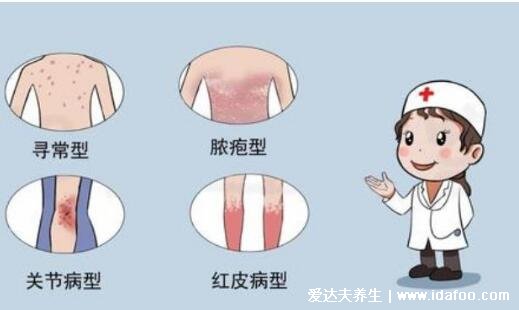 牛皮癣早期症状图片，丘疹变红斑有鳞屑瘙痒(全身可有)