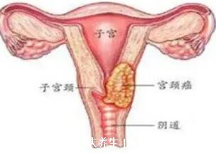 女性hpv是什么病毒图片，会导致宫颈癌的一种病毒(附真实图片)