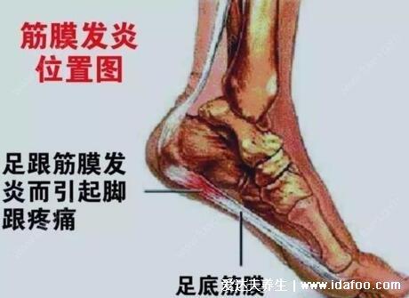 女性足底筋膜炎4个痛点图片，跟骨内上方最严重(3种止疼方法)