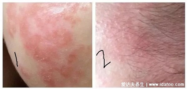 热痱子和湿疹的区别图，热痱子是一粒粒的（湿疹消散不快）