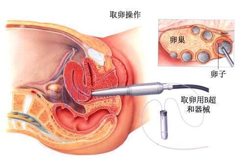 试管婴儿怎么做的全过程，有图一下子看懂(取卵要做好心理准备)