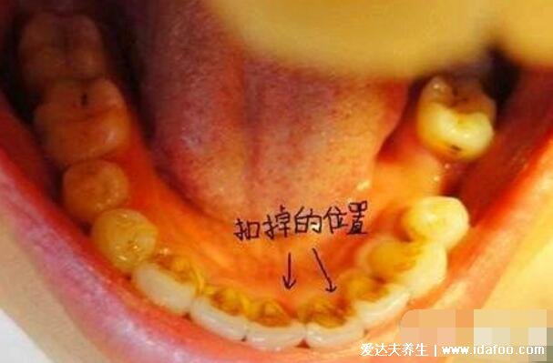 牙结石图片及形成原因，牙结石可以自己抠掉吗(不行)