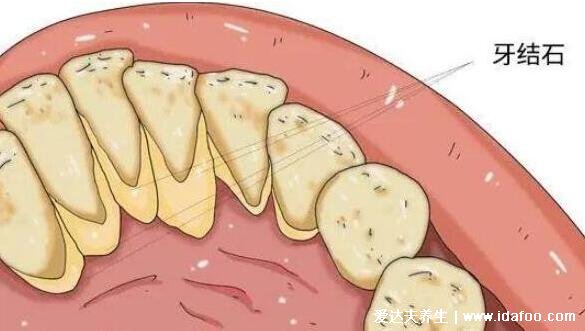 牙结石怎么自己去除图片，妙用白醋小苏打白矾(不可以用手扣)