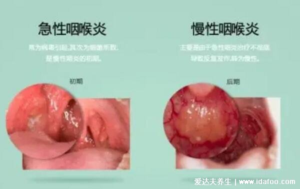 一勺白醋治好咽炎是真的吗，对轻微咽炎有一些好处但效果不佳