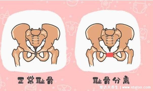 孕妇耻骨位置图，大腿跟内侧和小肚子交界处(缓解疼痛方法)