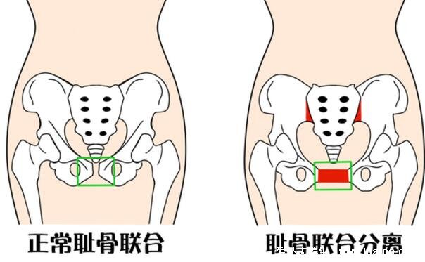 孕妇耻骨在哪个位置示意图片，大腿跟内侧有骨头的地方(附缓解法)