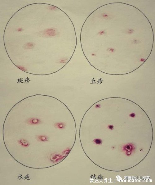 怎么判断是不是水痘图片，附7天演变过程(红色斑点类似蚊子包)