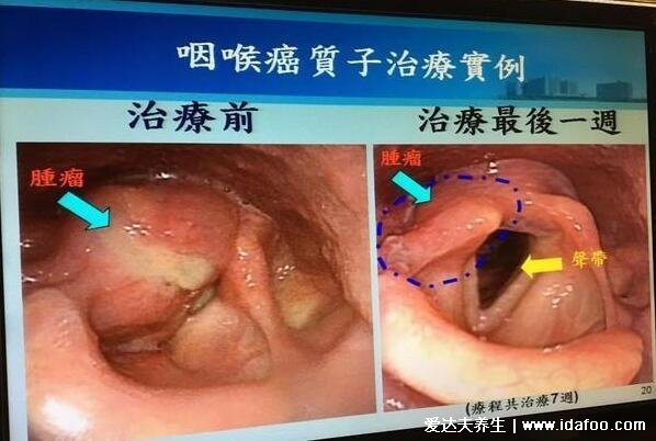 喉癌的早期症状和前兆图片，警惕咳嗽痰中带血/脖子有肿块的情况