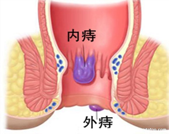 内外痔疮最佳的自愈方法，无花果叶偏方适合外痔/温盐水坐浴(5种方法)