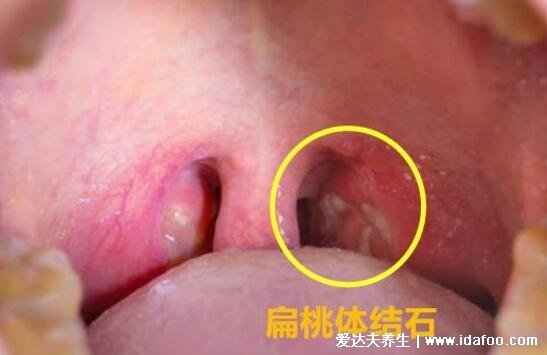 扁桃体结石脱落小妙招图片，口腔里吐出了个小黄粒巨臭