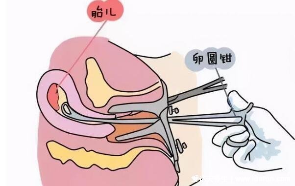 流产掉下来的完整孕囊图片，有肉感的粉白囊状物(胆小慎入)