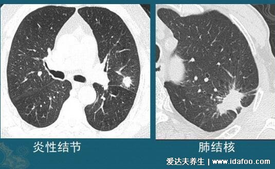 肺部结节最怕三个征兆，警惕磨玻璃样的结节(5%会癌变)