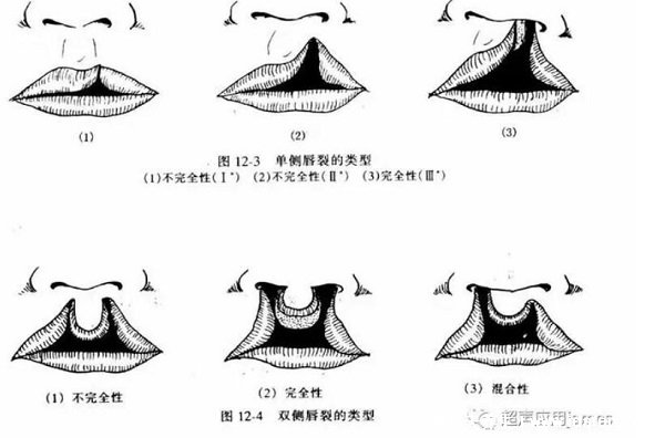 唇腭裂图片是什么样子图片，1侧或2边嘴巴开裂(孕早期要预防)