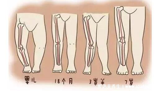 罗圈腿图片是什么样子，o型腿怎么矫正动作图