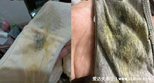 细菌性阴炎的主要症状图片，灰白色稀薄状白带有鱼腥味(4大症状)