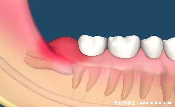 拔智齿后那个洞臭到恶心，拔牙后3-5天痛不欲生警惕干槽症