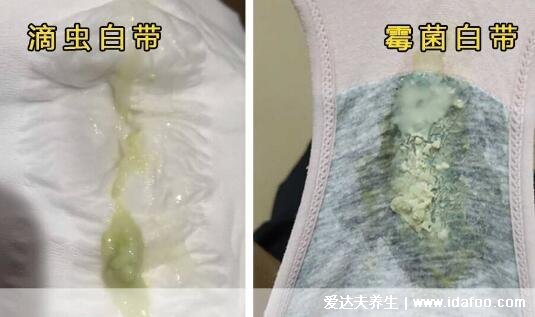 滴虫性阴炎的主要症状图片，黄绿色泡沫状白带注意和霉菌阴炎区分