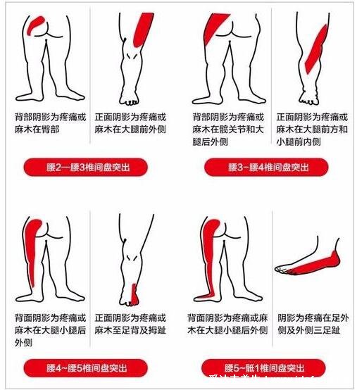 腰肌劳损疼痛的部位图片，注意和腰间盘突出区分(附治疗法)