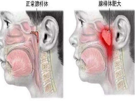 切除腺样体后悔到家了，孩子遭罪家长心疼还有复发风险(但不做危害大)