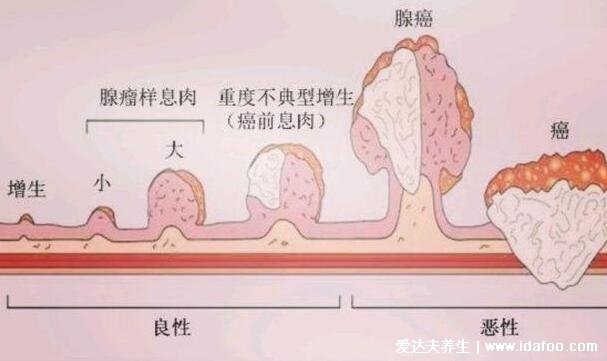 肠癌放屁特点及大便变细的图片，放屁多且臭还夹杂血性分泌物