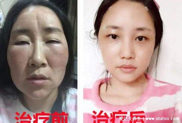 女性甲减最明显的症状，不仅仅是容貌异常还会导致不孕