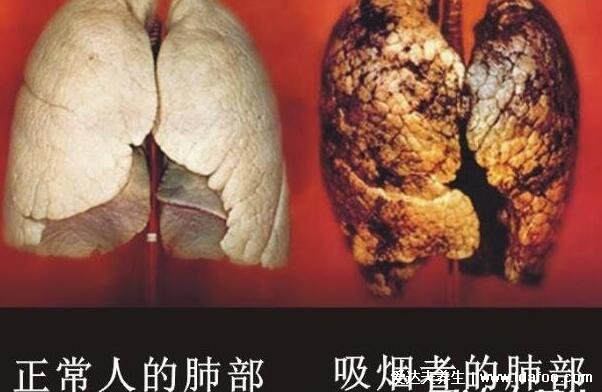 长期抽电子烟体检报告出来了，出现多个良性肺部结节(警惕癌变)