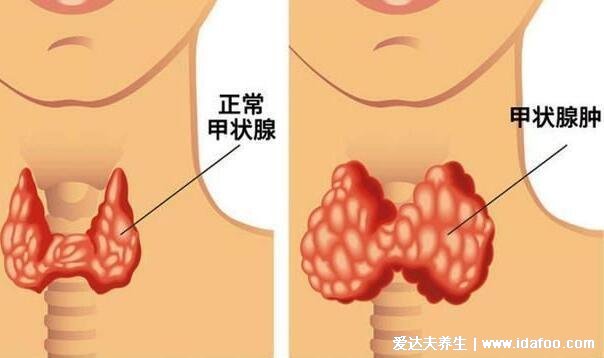 女性甲状腺的前兆图片，甲减会导致容貌异常还影响生育