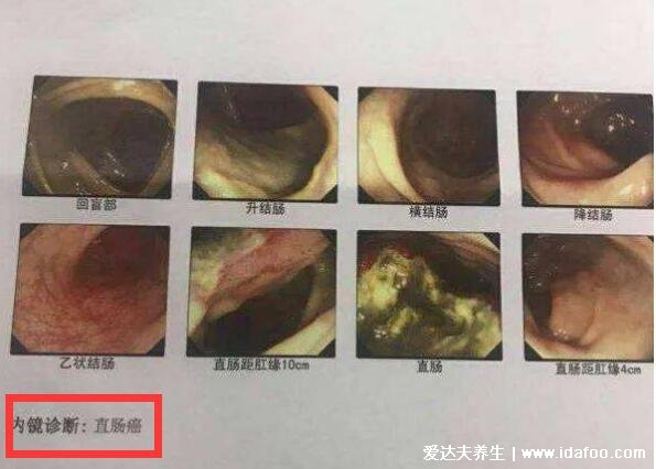 肠炎与肠癌最明显区别，对比症状简单自测(附肠癌拉出来大便的图片)