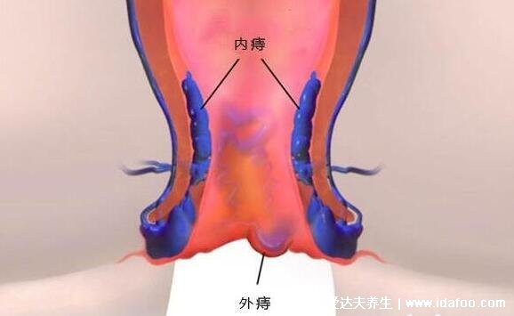 真实的外痔疮图片长什么样?能摸到肛门口有个肉球(附自愈方法)