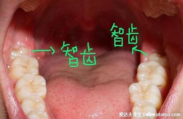 智齿有必要拔吗，看清不需要拔的智齿图片(附智齿拔牙后窟窿恢复图)