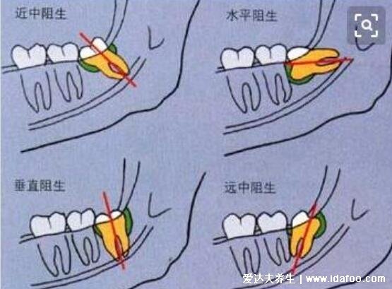 拔智齿注意事项与禁忌，过来人经验(附智齿拔牙后窟窿恢复图)