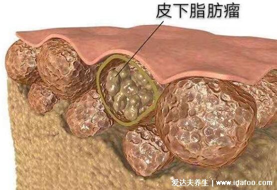 皮瘤长什么样子图片，初期皮下脂肪瘤图片及症状