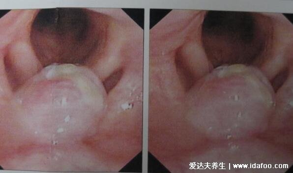 警惕喉癌的5大早期症状图片，中了两点的赶紧去医院做检查