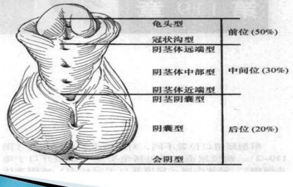 尿道下裂是什么病图片及症状，男性多发的先天畸形病(5种类型)