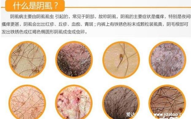 去阴虱子最简单的方法，4步教你彻底根治(附私处长阴虱虫子图片)