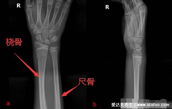 肱骨在哪个位置图片，人体连接肩部和上臂的粗壮骨头(示意图)