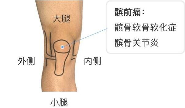 膝盖疼痛可能有三种病，膝盖各个部位疼痛图解(关节炎最常见)