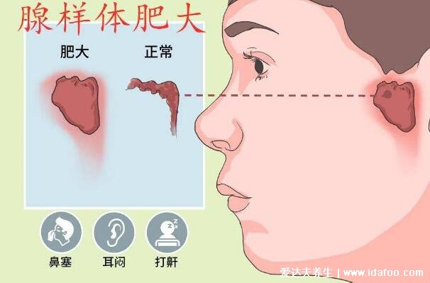 腺样体面容容貌变丑图片，怎么判断小孩腺样体肥大的症状