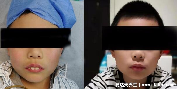 腺样体面容容貌变丑图片，怎么判断小孩腺样体肥大的症状