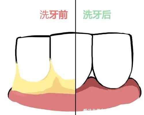 深度洗牙后多久可以刷牙，建议一小时后再刷牙