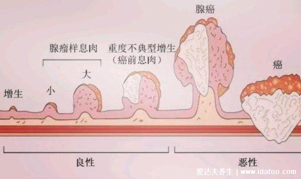 直肠癌早期的5大症状，左下腹肛门隐隐作痛伴随大便变细带血