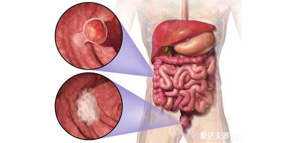 直肠癌早期的5大症状，左下腹肛门隐隐作痛伴随大便变细带血