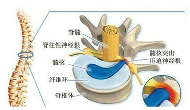 腰椎间盘突出压迫神经腿疼怎么治，药物和保守疗法一般不需要手术