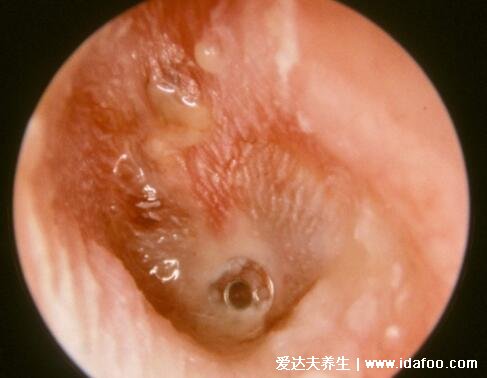 中耳炎症状有哪些表现，耳痛流脓听力下降伴随全身症状(图片)